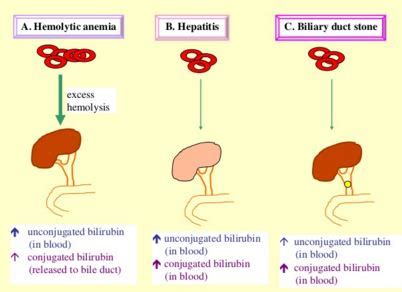 What Bilirubin in Urine Means: Causes, Symptoms